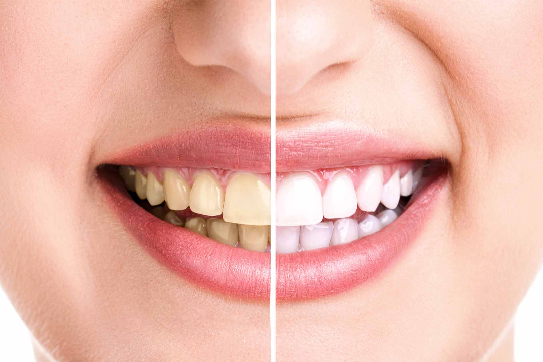 hamlin dental group teeth whitening