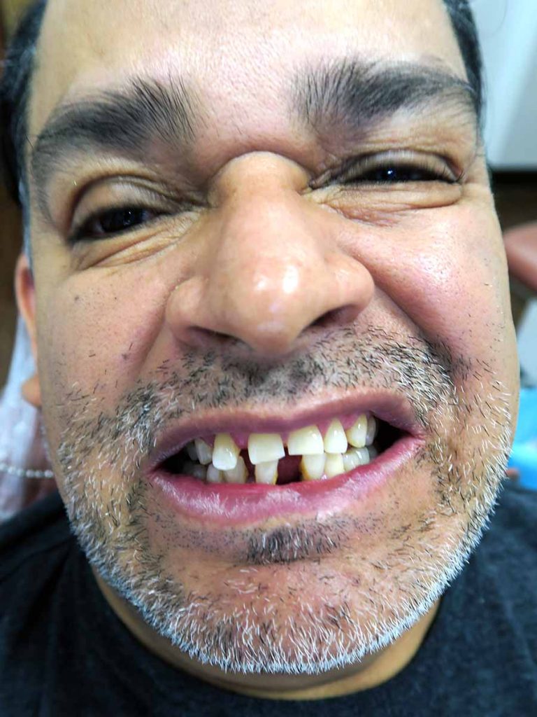 hamlin dental group patient smile before treatment