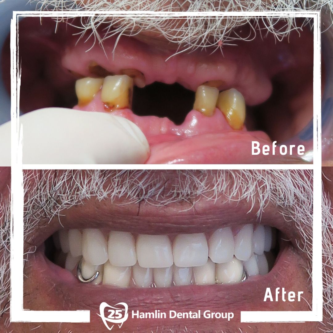 Partial and Denture Hamlin Dental Group