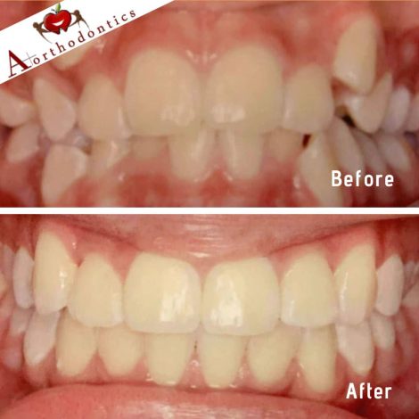 A+-Orthodontics-Before-and-After-Comparison-2