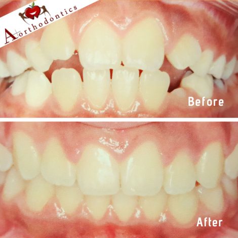 A+-Orthodontics-Before-and-After-Comparison-3