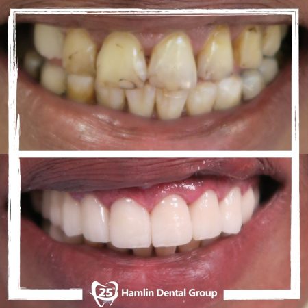 Cosmetic Dentistry Hamlin Dental Group 2020 _3