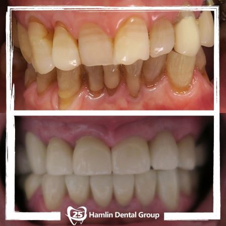 Cosmetic Dentistry Hamlin Dental Group 2020 _4