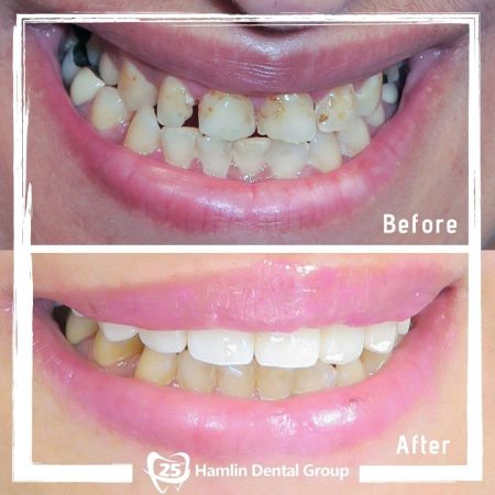 Teeth Whitening Hamlin Dental Group